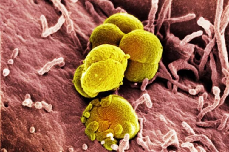 Curare la gonorrea in modo naturale: ecco i rimedi della nonna